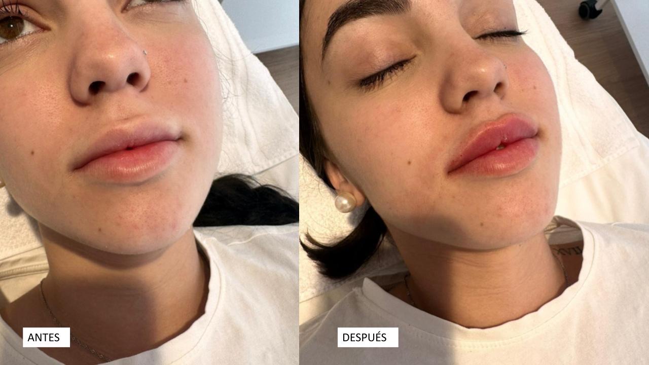 Antes y después de un aumento de labios con ácido hialurónico en Clínica Marchesi