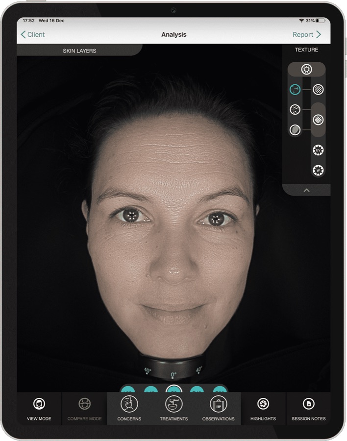 Skin texture analysis with OBSERV 520x at Clínica Marchesi