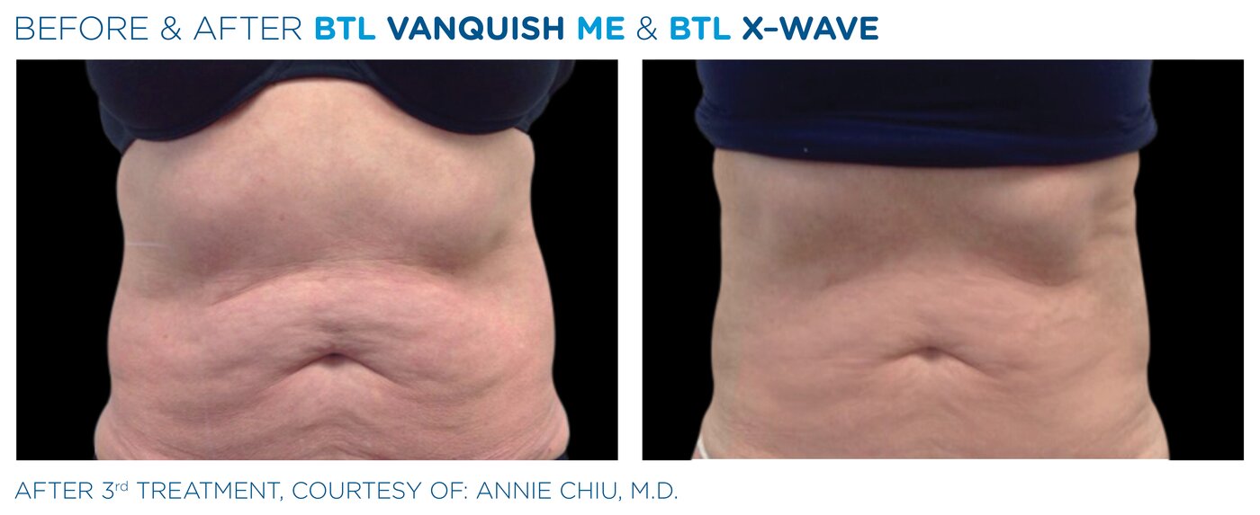 Shockwave therapy treatment at Clínica Marchesi