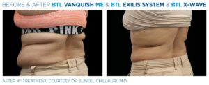 Reductor de Grasa y Celulitis